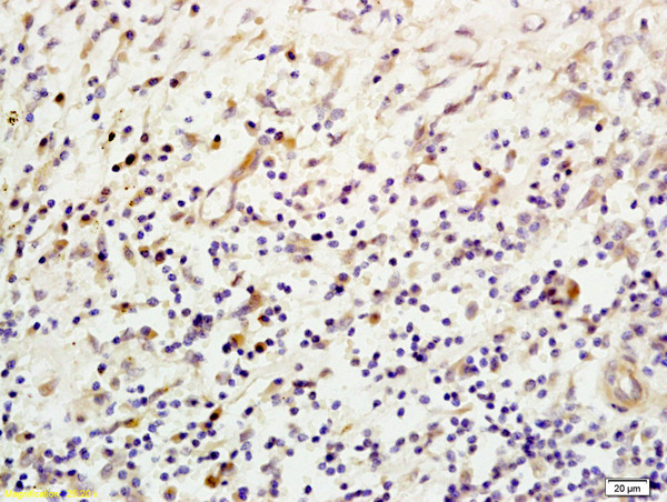 Formalin-fixed and paraffin embedded human esophageal carcinoma labeled with Anti- Mannan Binding Lectin Polyclonal Antibody, Unconjugated (bs-1582R) at 1:200, followed by conjugation to the secondary antibody and DAB staining.