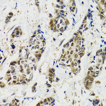 Paraformaldehyde-fixed, paraffin embedded Human breast cancer; Antigen retrieval by boiling in sodium citrate buffer (pH6.0) for 15min; Block endogenous peroxidase by 3% hydrogen peroxide for 20 minutes; Blocking buffer (normal goat serum) at 37°C for 30min; Antibody incubation with _x000D_ MAPK9 Polyclonal Antibody, Unconjugated (bs-55130R) at 1:100 overnight at 4°C, DAB staining.