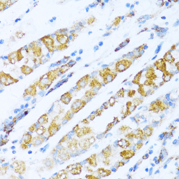 Paraformaldehyde-fixed, paraffin embedded Human gastric carcinoma; Antigen retrieval by boiling in sodium citrate buffer (pH6.0) for 15min; Block endogenous peroxidase by 3% hydrogen peroxide for 20 minutes; Blocking buffer (normal goat serum) at 37°C for 30min; Antibody incubation with NDUFA5 Polyclonal Antibody, Unconjugated (bs-55143R) at 1:100 overnight at 4°C, DAB staining.