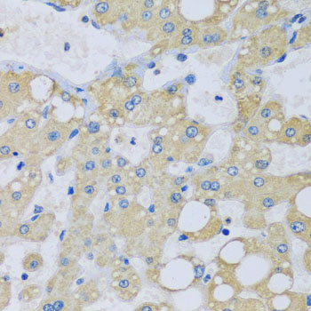 Paraformaldehyde-fixed, paraffin embedded Human liver damage; Antigen retrieval by boiling in sodium citrate buffer (pH6.0) for 15min; Block endogenous peroxidase by 3% hydrogen peroxide for 20 minutes; Blocking buffer (normal goat serum) at 37°C for 30min; Antibody incubation with NDUFA7 Polyclonal Antibody, Unconjugated (bs-55144R) at 1:100 overnight at 4°C, DAB staining.