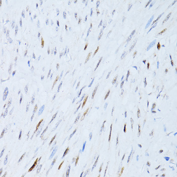 Paraformaldehyde-fixed, paraffin embedded Human endometrial carcinoma; Antigen retrieval by boiling in sodium citrate buffer (pH6.0) for 15min; Block endogenous peroxidase by 3% hydrogen peroxide for 20 minutes; Blocking buffer (normal goat serum) at 37°C for 30min; Antibody incubation with _x000D_ P21 Polyclonal Antibody, Unconjugated (bs-55160R) at 1:100 overnight at 4°C, DAB staining.