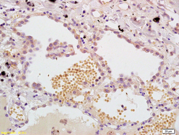 Formalin-fixed and paraffin embedded human lung carcinoma labeled with Anti- MASP Polyclonal Antibody, Unconjugated (bs-1723R) at 1:200, followed by conjugation to the secondary antibody and DAB staining.