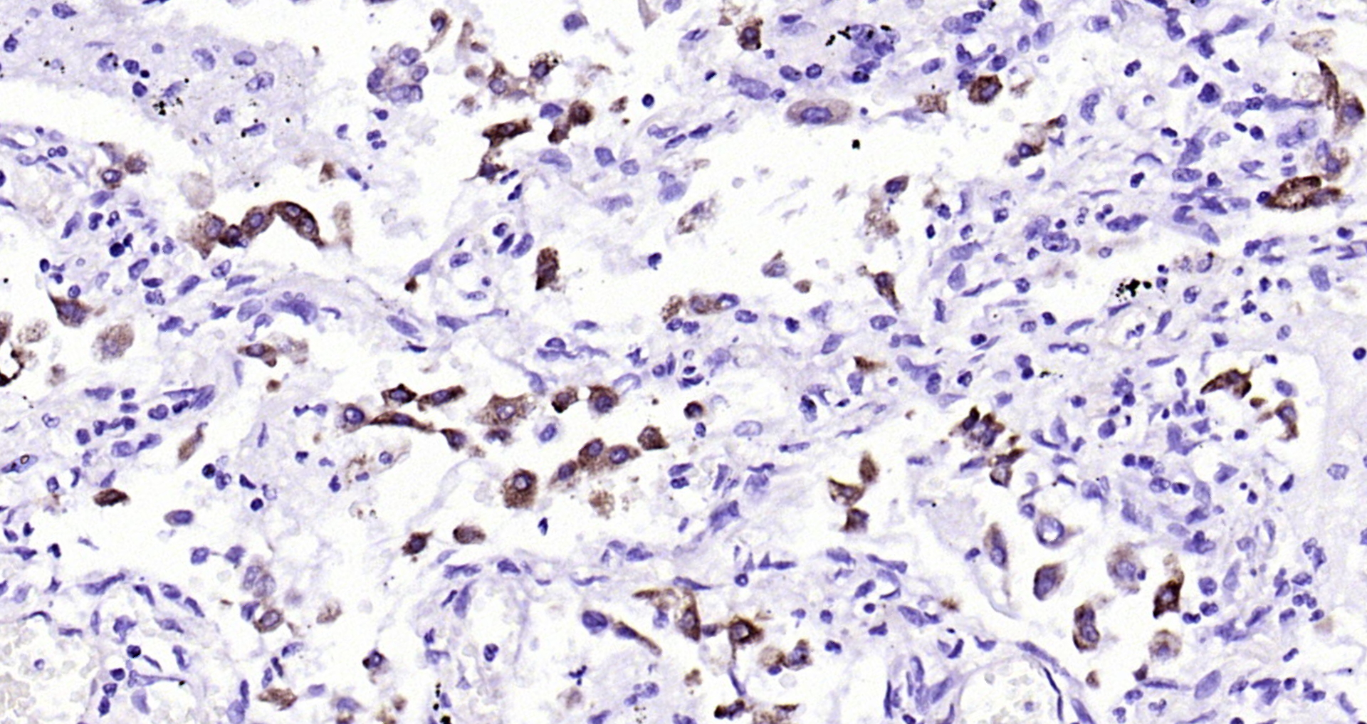 Paraformaldehyde-fixed, paraffin embedded Human lung cancer; Antigen retrieval by boiling in sodium citrate buffer (pH6.0) for 15min; Block endogenous peroxidase by 3% hydrogen peroxide for 20 minutes; Blocking buffer (normal goat serum) at 37°C for 30min; Antibody incubation with AGR2 (3F8) Monoclonal Antibody, Unconjugated (bsm-52594R) at 1:200 overnight at 4°C, DAB staining.