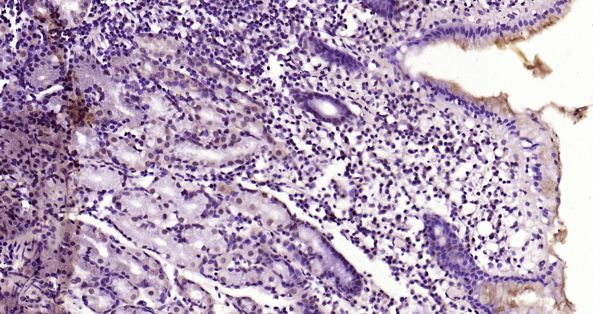 Paraformaldehyde-fixed, paraffin embedded Human gastric carcinoma; Antigen retrieval by boiling in sodium citrate buffer (pH6.0) for 15min; Block endogenous peroxidase by 3% hydrogen peroxide for 20 minutes; Blocking buffer (normal goat serum) at 37°C for 30min; Antibody incubation with FADD (Ser194) Polyclonal Antibody, Unconjugated (bs-5699R) at 1:200 overnight at 4°C, DAB staining.