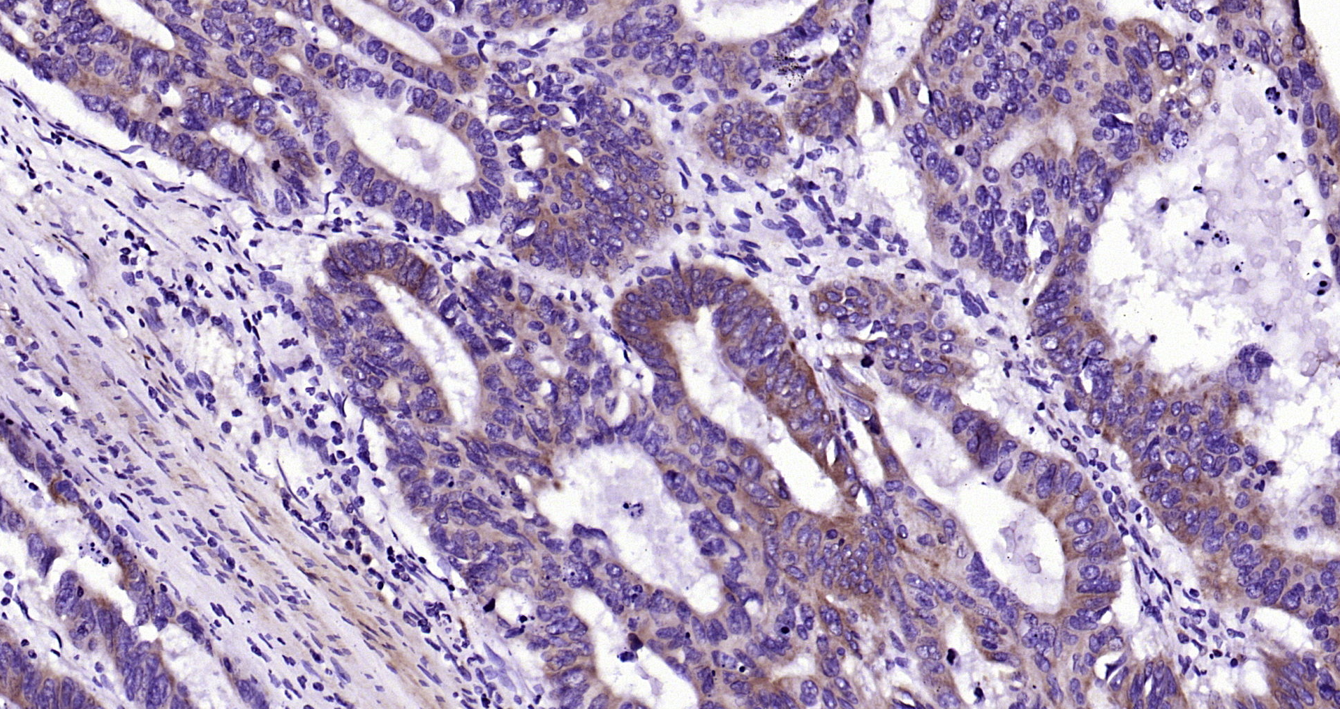 Paraformaldehyde-fixed, paraffin embedded Human colon cancer; Antigen retrieval by boiling in sodium citrate buffer (pH6.0) for 15min; Block endogenous peroxidase by 3% hydrogen peroxide for 20 minutes; Blocking buffer (normal goat serum) at 37°C for 30min; Antibody incubation with MEK2 (4C3) Monoclonal Antibody, Unconjugated (bsm-33216M) at 1:200 overnight at 4°C, DAB staining.