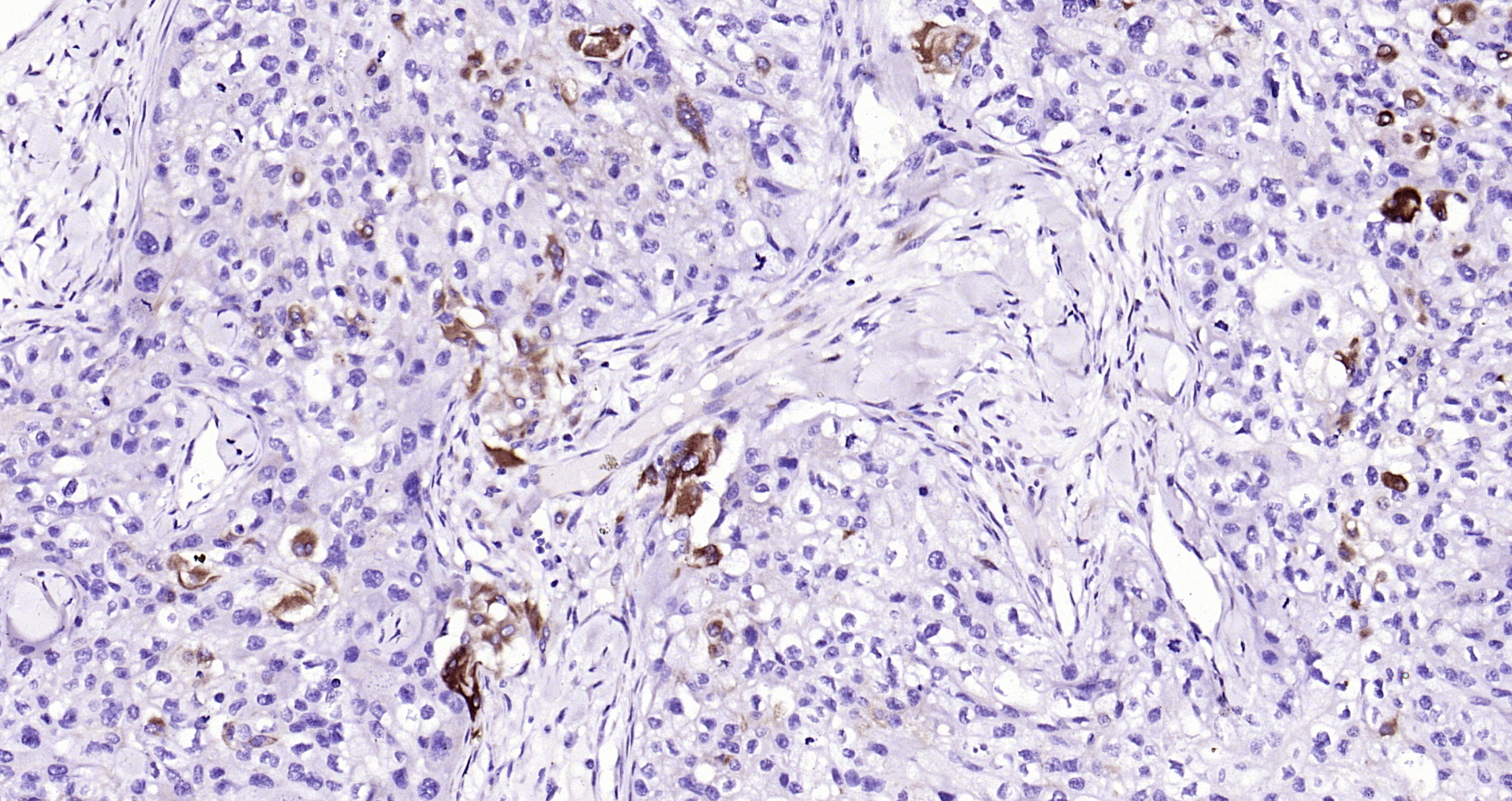 Paraformaldehyde-fixed, paraffin embedded Human skin cancer; Antigen retrieval by boiling in sodium citrate buffer (pH6.0) for 15min; Block endogenous peroxidase by 3% hydrogen peroxide for 20 minutes; Blocking buffer (normal goat serum) at 37°C for 30min; Antibody incubation with MEK2 (4C3) Monoclonal Antibody, Unconjugated (bsm-33216M) at 1:200 overnight at 4°C, DAB staining.