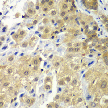 Paraformaldehyde-fixed, paraffin embedded Human liver cancer; Antigen retrieval by boiling in sodium citrate buffer (pH6.0) for 15min; Block endogenous peroxidase by 3% hydrogen peroxide for 20 minutes; Blocking buffer (normal goat serum) at 37°C for 30min; Antibody incubation with SGTA Polyclonal Antibody, Unconjugated (bs-55197R) at 1:100 overnight at 4°C, DAB staining.