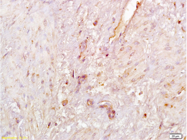 Formalin-fixed and paraffin embedded human endometrial carcinoma labeled with Anti-SIRT1 Polyclonal Antibody, Unconjugated (bs-0921R) at 1:200, followed by conjugation to the secondary antibody and DAB staining