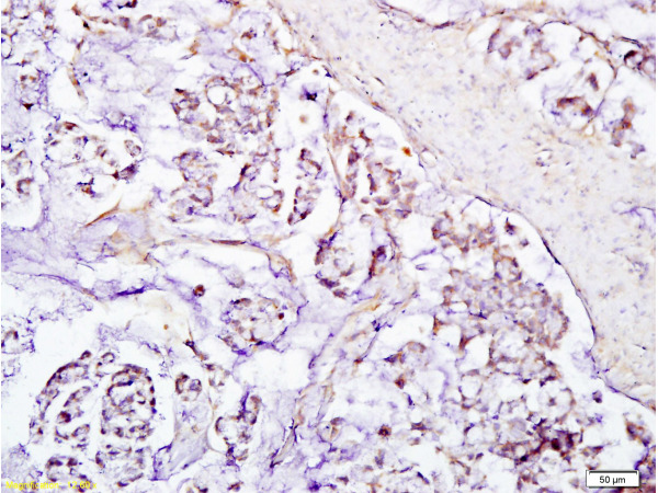 Formalin-fixed and paraffin embedded human gastric carcinoma labeled with Anti-SIRT1 Polyclonal Antibody, Unconjugated (bs-0921R) at 1:200, followed by conjugation to the secondary antibody and DAB staining