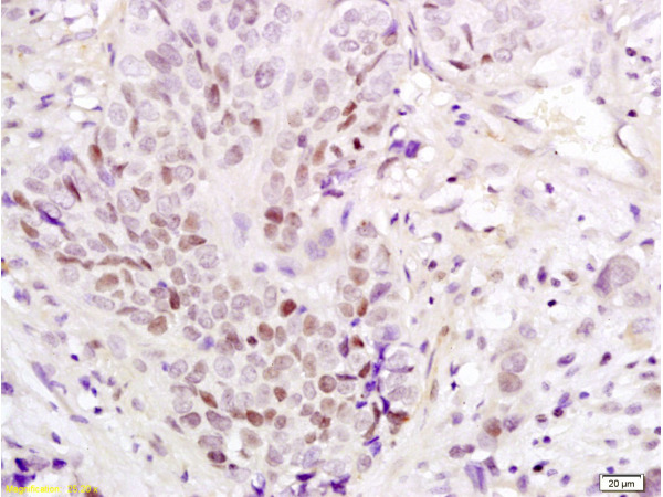 Formalin-fixed and paraffin embedded human esophageal carcinoma labeled with Anti-PAX3 Polyclonal Antibody, Unconjugated(bs-1097R) at 1:200 followed by conjugation to the secondary antibody and DAB staining