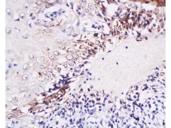 Formalin-fixed and paraffin embedded Human oral mucosa labeled with Anti-IL-6(human) Polyclonal Antibody, Unconjugated (bs-0781R) at 1:200, followed by conjugation to the secondary antibody and DAB staining