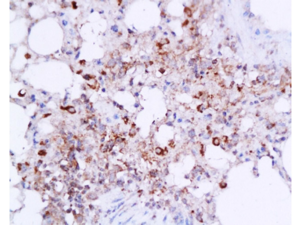 Formalin-fixed and paraffin embedded mouse lung tissue labeled with Anti-IL-6(mo, rat) Polyclonal Antibody, Unconjugated (bs-0782R) at 1:200, followed by conjugation to the secondary antibody and DAB staining