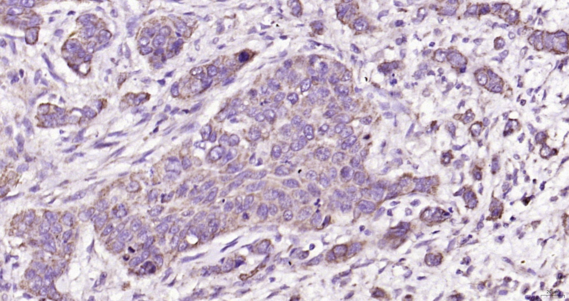 Paraformaldehyde-fixed, paraffin embedded Human esophageal carcinoma; Antigen retrieval by boiling in sodium citrate buffer (pH6.0) for 15min; Block endogenous peroxidase by 3% hydrogen peroxide for 20 minutes; Blocking buffer (normal goat serum) at 37°C for 30min; Antibody incubation with TM4SF3 Polyclonal Antibody, Unconjugated (bs-6241R) at 1:200 overnight at 4°C, DAB staining.