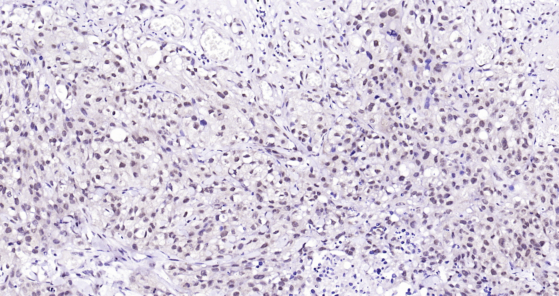 Paraformaldehyde-fixed, paraffin embedded Human skin cancer; Antigen retrieval by boiling in sodium citrate buffer (pH6.0) for 15min; Block endogenous peroxidase by 3% hydrogen peroxide for 20 minutes; Blocking buffer (normal goat serum) at 37°C for 30min; Antibody incubation with Ubiquitin Monoclonal Antibody, Unconjugated (bsm-33307M) at 1:200 overnight at 4°C, DAB staining.