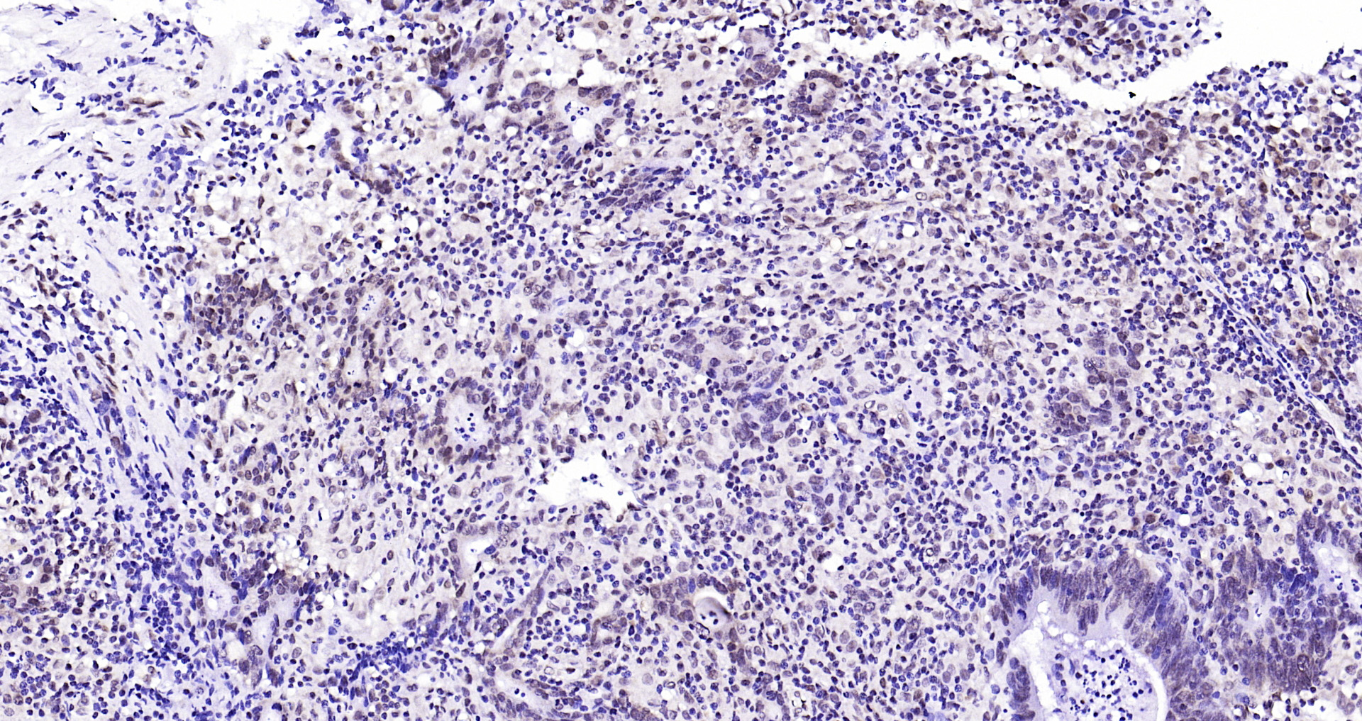 Paraformaldehyde-fixed, paraffin embedded Human gastric carcinoma; Antigen retrieval by boiling in sodium citrate buffer (pH6.0) for 15min; Block endogenous peroxidase by 3% hydrogen peroxide for 20 minutes; Blocking buffer (normal goat serum) at 37°C for 30min; Antibody incubation with Ubiquitin Monoclonal Antibody, Unconjugated (bsm-33307M) at 1:200 overnight at 4°C, DAB staining.