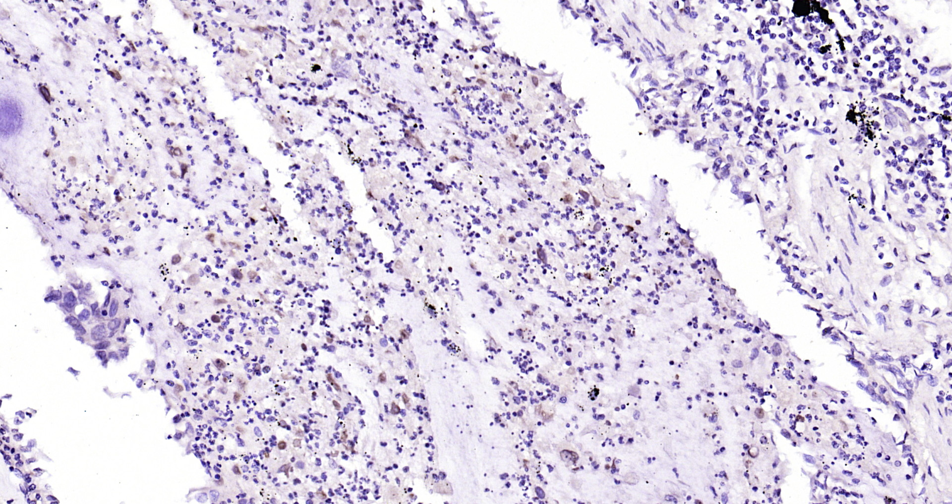 Paraformaldehyde-fixed, paraffin embedded Human lung cancer; Antigen retrieval by boiling in sodium citrate buffer (pH6.0) for 15min; Block endogenous peroxidase by 3% hydrogen peroxide for 20 minutes; Blocking buffer (normal goat serum) at 37°C for 30min; Antibody incubation with FIGNL1 Polyclonal Antibody, Unconjugated (bs-9433R) at 1:200 overnight at 4°C, DAB staining.