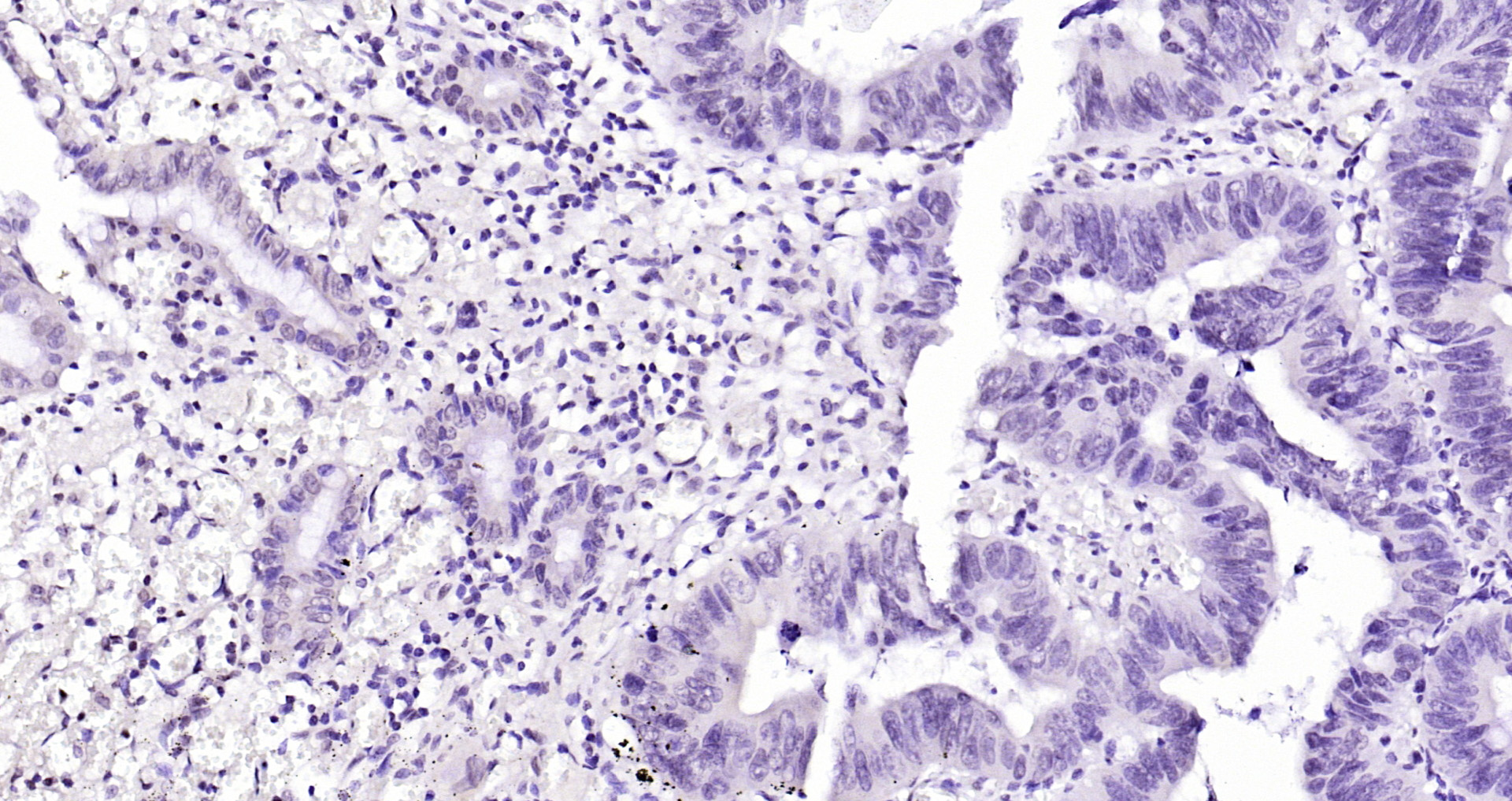 Paraformaldehyde-fixed, paraffin embedded Human colon cancer; Antigen retrieval by boiling in sodium citrate buffer (pH6.0) for 15min; Block endogenous peroxidase by 3% hydrogen peroxide for 20 minutes; Blocking buffer (normal goat serum) at 37°C for 30min; Antibody incubation with FIGNL1 Polyclonal Antibody, Unconjugated (bs-9433R) at 1:200 overnight at 4°C, DAB staining.