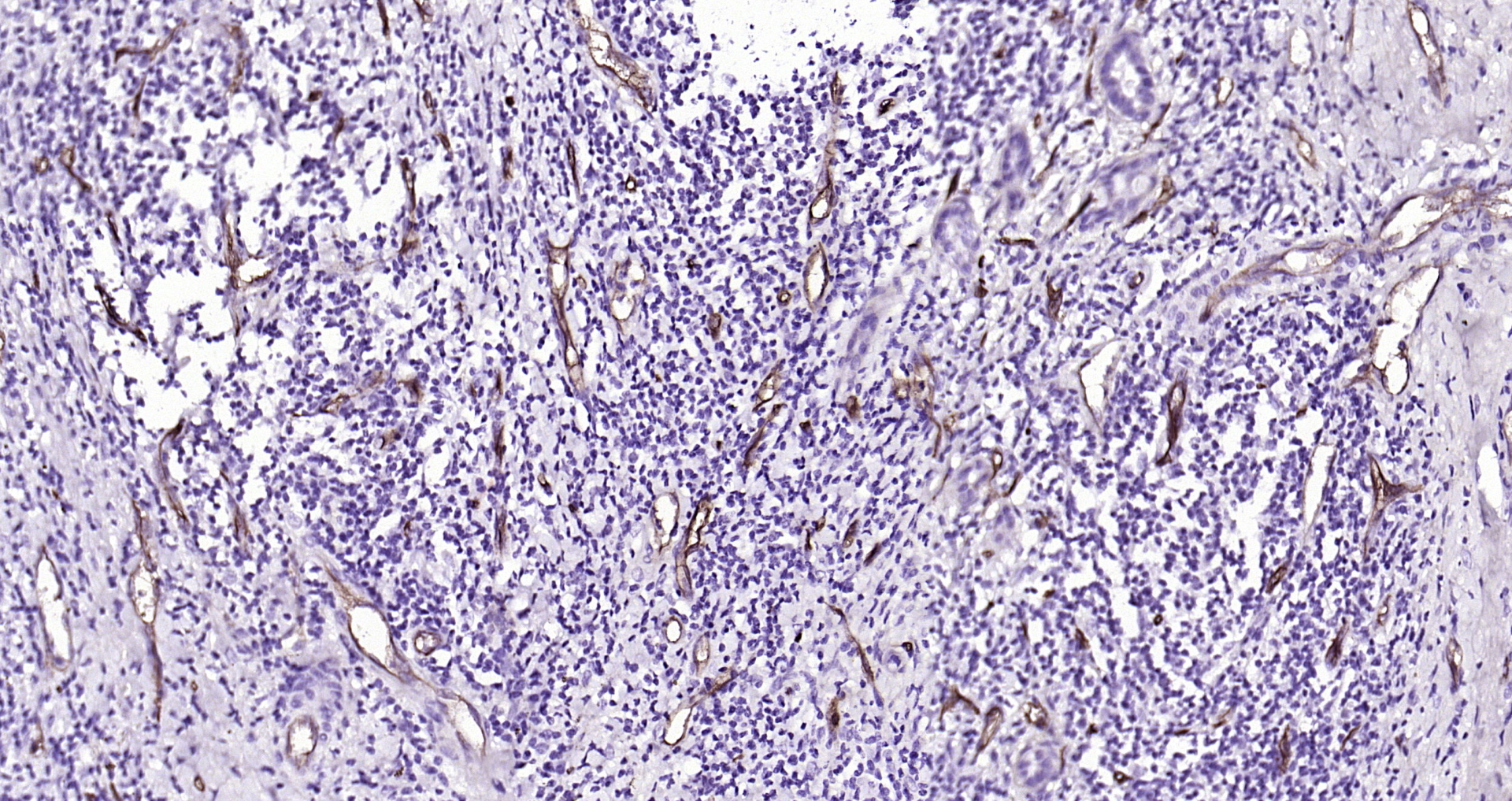 Paraformaldehyde-fixed, paraffin embedded Human liver cancer; Antigen retrieval by boiling in sodium citrate buffer (pH6.0) for 15min; Block endogenous peroxidase by 3% hydrogen peroxide for 20 minutes; Blocking buffer (normal goat serum) at 37°C for 30min; Antibody incubation with CD34 Monoclonal Antibody, Unconjugated (bsm-41196M) at 1:400 overnight at 4°C, DAB staining.