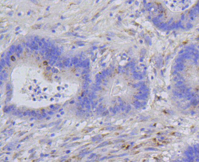 Paraformaldehyde-fixed, paraffin embedded Human colon cancer; Antigen retrieval by boiling in sodium citrate buffer (pH6.0) for 15min; Block endogenous peroxidase by 3% hydrogen peroxide for 20 minutes; Blocking buffer (normal goat serum) at 37°C for 30min; Antibody incubation with Phospho-Histone H1.3(T17)+Histone H1.4(T17) Monoclonal Antibody, Unconjugated (bsm-54480R) at 1:200 for 30 minutes at room temperature, DAB staining.