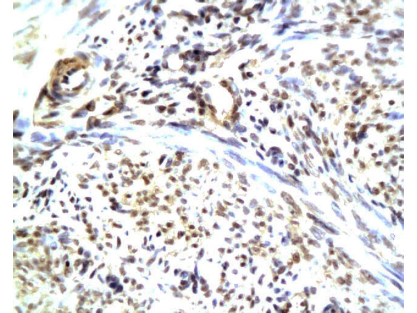 Formalin-fixed and paraffin embedded human endometrium carcinoma with Anti-CGRP\/CGRP2 Polyclonal Antibody, Unconjugated(bs-0791R) at 1:200, followed by conjugation to the secondary antibody and DAB staining