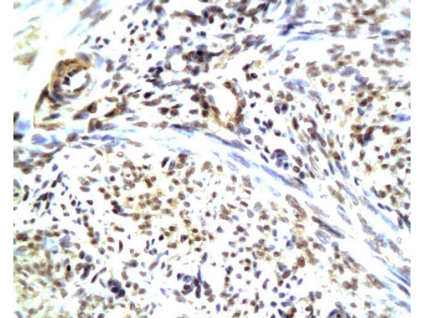 Formalin-fixed and paraffin embedded human endometrium carcinoma with Anti-CGRP/CGRP2 Polyclonal Antibody, Unconjugated(bs-0791R) at 1:200, followed by conjugation to the secondary antibody and DAB staining
