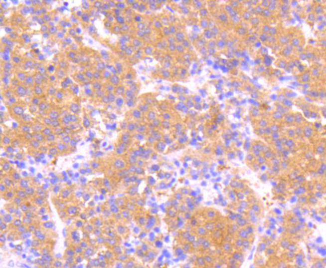 Paraformaldehyde-fixed, paraffin embedded Human liver cancer; Antigen retrieval by boiling in sodium citrate buffer (pH6.0) for 15min; Block endogenous peroxidase by 3% hydrogen peroxide for 20 minutes; Blocking buffer (normal goat serum) at 37°C for 30min; Antibody incubation with Phospho-MEK1(S218/S222) Monoclonal Antibody, Unconjugated (bsm-54527R) at 1:50 for 30 minutes at room temperature, DAB staining.