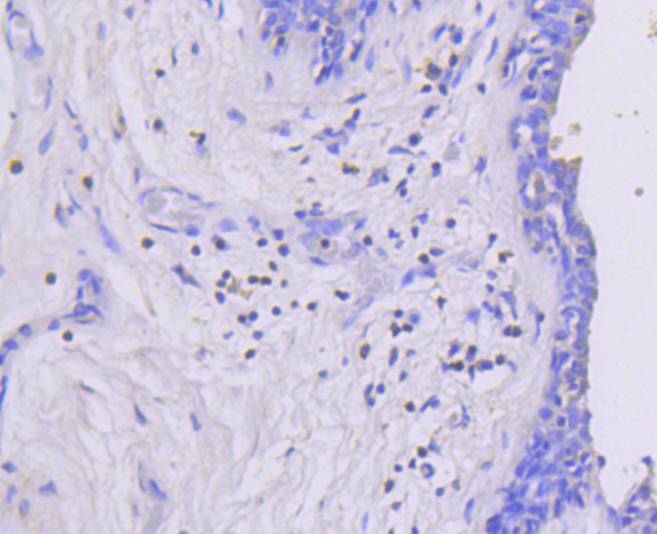 Paraformaldehyde-fixed, paraffin embedded Human breast cancer; Antigen retrieval by boiling in sodium citrate buffer (pH6.0) for 15min; Block endogenous peroxidase by 3% hydrogen peroxide for 20 minutes; Blocking buffer (normal goat serum) at 37°C for 30min; Antibody incubation with Phospho-MEK1(S218/S222) Monoclonal Antibody, Unconjugated (bsm-54527R) at 1:50 for 30 minutes at room temperature, DAB staining.