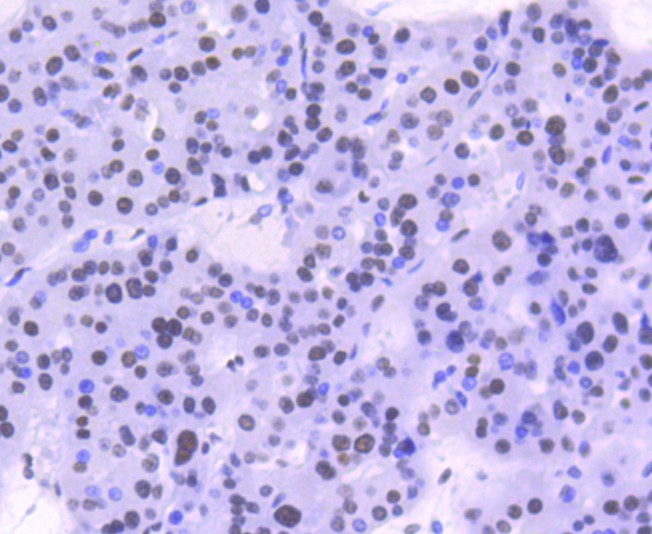 Paraformaldehyde-fixed, paraffin embedded Human liver cancer; Antigen retrieval by boiling in sodium citrate buffer (pH6.0) for 15min; Block endogenous peroxidase by 3% hydrogen peroxide for 20 minutes; Blocking buffer (normal goat serum) at 37°C for 30min; Antibody incubation with Phospho-STAT1(S727) Monoclonal Antibody, Unconjugated (bsm-54561R) at 1:50 for 30 minutes at room temperature, DAB staining.