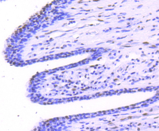 Paraformaldehyde-fixed, paraffin embedded Human breast cancer; Antigen retrieval by boiling in sodium citrate buffer (pH6.0) for 15min; Block endogenous peroxidase by 3% hydrogen peroxide for 20 minutes; Blocking buffer (normal goat serum) at 37°C for 30min; Antibody incubation with Phospho-STAT1(S727) Monoclonal Antibody, Unconjugated (bsm-54561R) at 1:50 for 30 minutes at room temperature, DAB staining.