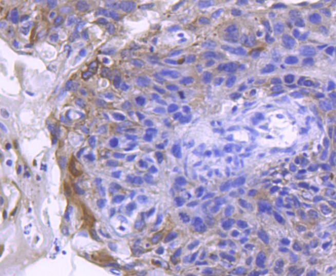 Paraformaldehyde-fixed, paraffin embedded Human breast cancer; Antigen retrieval by boiling in sodium citrate buffer (pH6.0) for 15min; Block endogenous peroxidase by 3% hydrogen peroxide for 20 minutes; Blocking buffer (normal goat serum) at 37°C for 30min; Antibody incubation with ACE2 Monoclonal Antibody, Unconjugated (bsm-54571R) at 1:50 for 30 minutes at room temperature, DAB staining.