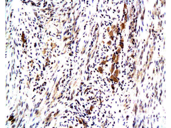 Formalin-fixed and paraffin embedded human colon carcinoma with Anti-Maspin Polyclonal Antibody, Unconjugated(bs-0792R) at 1:200, followed by conjugation to the secondary antibody and DAB staining