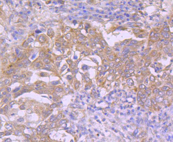 Paraformaldehyde-fixed, paraffin embedded Human lung cancer; Antigen retrieval by boiling in sodium citrate buffer (pH6.0) for 15min; Block endogenous peroxidase by 3% hydrogen peroxide for 20 minutes; Blocking buffer (normal goat serum) at 37°C for 30min; Antibody incubation with Cdk7 Monoclonal Antibody, Unconjugated (bsm-54616R) at 1:50 for 30 minutes at room temperature, DAB staining.