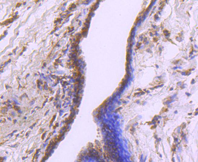 Paraformaldehyde-fixed, paraffin embedded Human breast cancer; Antigen retrieval by boiling in sodium citrate buffer (pH6.0) for 15min; Block endogenous peroxidase by 3% hydrogen peroxide for 20 minutes; Blocking buffer (normal goat serum) at 37°C for 30min; Antibody incubation with Cdk7 Monoclonal Antibody, Unconjugated (bsm-54616R) at 1:50 for 30 minutes at room temperature, DAB staining.