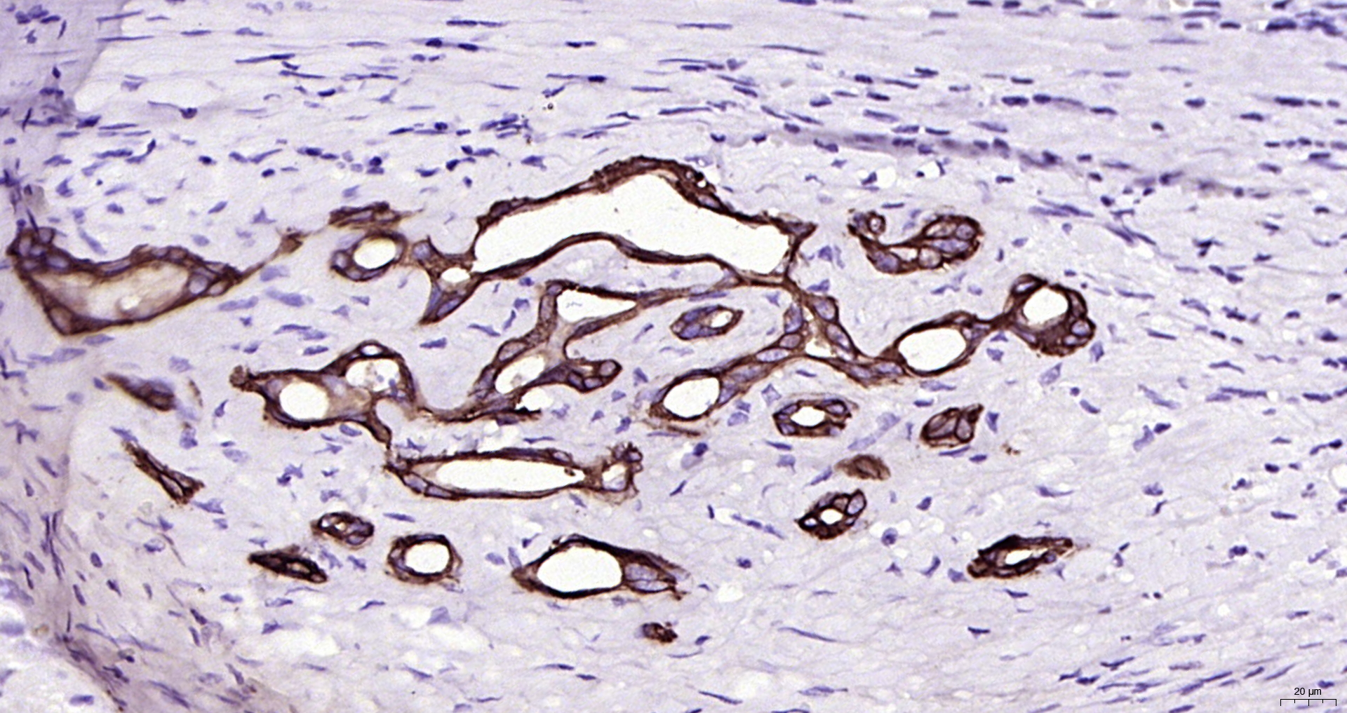 Paraformaldehyde-fixed, paraffin embedded Human liver cancer; Antigen retrieval by boiling in sodium citrate buffer (pH6.0) for 15min; Block endogenous peroxidase by 3% hydrogen peroxide for 20 minutes; Blocking buffer (normal goat serum) at 37°C for 30min; Antibody incubation with CYP26A1 Monoclonal Antibody, Unconjugated (bsm-54341R) at 1:200 overnight at 4°C, DAB staining.