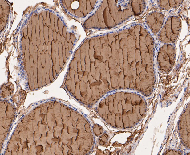 Paraformaldehyde-fixed, paraffin embedded Human thyroid; Antigen retrieval by boiling in sodium citrate buffer (pH6.0) for 15min; Block endogenous peroxidase by 3% hydrogen peroxide for 20 minutes; Blocking buffer (normal goat serum) at 37°C for 30min; Antibody incubation with Thyroglobulin Monoclonal Antibody, Unconjugated (bsm-54657R) at 1:50 for 30 minutes at room temperature, DAB staining. Paraformaldehyde-fixed, paraffin embedded Human thyroid; Antigen retrieval by boiling in sodium citrate buffer (pH6.0) for 15min; Block endogenous peroxidase by 3% hydrogen peroxide for 20 minutes; Blocking buffer (normal goat serum) at 37°C for 30min; Antibody incubation with Thyroglobulin Monoclonal Antibody, Unconjugated (bsm-54657R) at 1:50 for 30 minutes at room temperature, DAB staining.