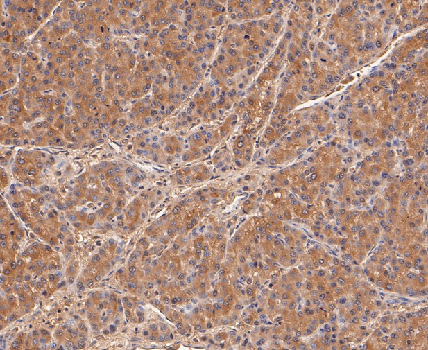 Paraformaldehyde-fixed, paraffin embedded Human liver cancer; Antigen retrieval by boiling in sodium citrate buffer (pH6.0) for 15min; Block endogenous peroxidase by 3% hydrogen peroxide for 20 minutes; Blocking buffer (normal goat serum) at 37°C for 30min; Antibody incubation with Calpain small subunit 1 Monoclonal Antibody, Unconjugated (bsm-54658R) at 1:50 for 30 minutes at room temperature, DAB staining.