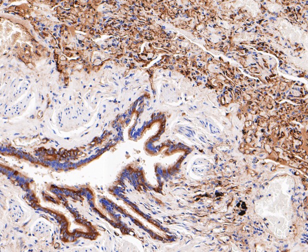 Paraformaldehyde-fixed, paraffin embedded Human lung; Antigen retrieval by boiling in sodium citrate buffer (pH6.0) for 15min; Block endogenous peroxidase by 3% hydrogen peroxide for 20 minutes; Blocking buffer (normal goat serum) at 37°C for 30min; Antibody incubation with Tryptophanyl tRNA synthetase / WRS Monoclonal Antibody, Unconjugated (bsm-54661R) at 1:200 for 30 minutes at room temperature, DAB staining.