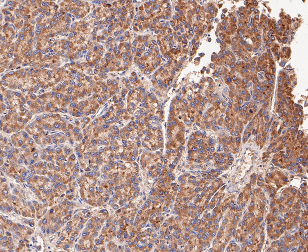 Paraformaldehyde-fixed, paraffin embedded Human liver cancer; Antigen retrieval by boiling in sodium citrate buffer (pH6.0) for 15min; Block endogenous peroxidase by 3% hydrogen peroxide for 20 minutes; Blocking buffer (normal goat serum) at 37°C for 30min; Antibody incubation with ACADM Monoclonal Antibody, Unconjugated (bsm-54662R) at 1:50 for 30 minutes at room temperature, DAB staining.