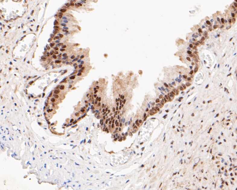 Paraformaldehyde-fixed, paraffin embedded Human prostate cancer; Antigen retrieval by boiling in sodium citrate buffer (pH6.0) for 15min; Block endogenous peroxidase by 3% hydrogen peroxide for 20 minutes; Blocking buffer (normal goat serum) at 37°C for 30min; Antibody incubation with HSF2 Monoclonal Antibody, Unconjugated (bsm-54665R) at 1:50 for 30 minutes at room temperature, DAB staining.