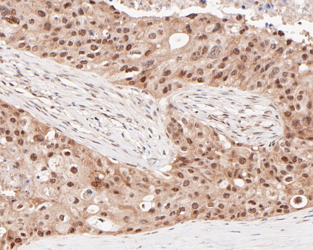 Paraformaldehyde-fixed, paraffin embedded Human breast cancer; Antigen retrieval by boiling in sodium citrate buffer (pH6.0) for 15min; Block endogenous peroxidase by 3% hydrogen peroxide for 20 minutes; Blocking buffer (normal goat serum) at 37°C for 30min; Antibody incubation with HSF2 Monoclonal Antibody, Unconjugated (bsm-54665R) at 1:50 for 30 minutes at room temperature, DAB staining.