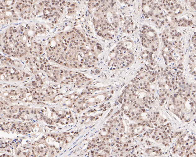 Paraformaldehyde-fixed, paraffin embedded Human gastric carcinoma; Antigen retrieval by boiling in sodium citrate buffer (pH6.0) for 15min; Block endogenous peroxidase by 3% hydrogen peroxide for 20 minutes; Blocking buffer (normal goat serum) at 37°C for 30min; Antibody incubation with HSF2 Monoclonal Antibody, Unconjugated (bsm-54665R) at 1:200 for 30 minutes at room temperature, DAB staining.