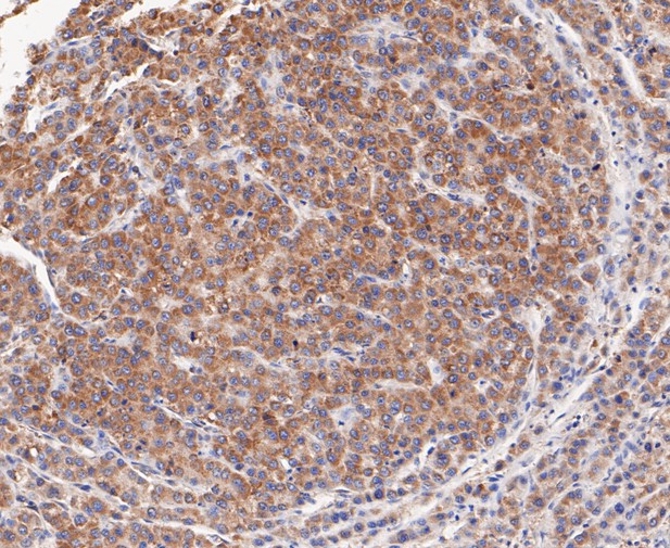 Paraformaldehyde-fixed, paraffin embedded Human liver cancer; Antigen retrieval by boiling in sodium citrate buffer (pH6.0) for 15min; Block endogenous peroxidase by 3% hydrogen peroxide for 20 minutes; Blocking buffer (normal goat serum) at 37°C for 30min; Antibody incubation with TCP1 alpha/CCTA Monoclonal Antibody, Unconjugated (bsm-54666R) at 1:50 for 30 minutes at room temperature, DAB staining. Paraformaldehyde-fixed, paraffin embedded Human liver cancer; Antigen retrieval by boiling in sodium citrate buffer (pH6.0) for 15min; Block endogenous peroxidase by 3% hydrogen peroxide for 20 minutes; Blocking buffer (normal goat serum) at 37°C for 30min; Antibody incubation with TCP1 alpha/CCTA Monoclonal Antibody, Unconjugated (bsm-54666R) at 1:50 for 30 minutes at room temperature, DAB staining.