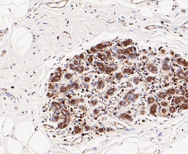 Paraformaldehyde-fixed, paraffin embedded Human breast; Antigen retrieval by boiling in sodium citrate buffer (pH6.0) for 15min; Block endogenous peroxidase by 3% hydrogen peroxide for 20 minutes; Blocking buffer (normal goat serum) at 37°C for 30min; Antibody incubation with TCP1 alpha/CCTA Monoclonal Antibody, Unconjugated (bsm-54666R) at 1:50 for 30 minutes at room temperature, DAB staining.