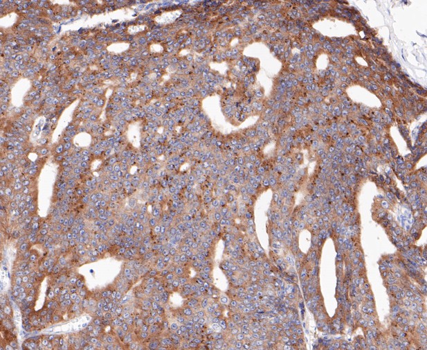 Paraformaldehyde-fixed, paraffin embedded Human prostate cancer; Antigen retrieval by boiling in sodium citrate buffer (pH6.0) for 15min; Block endogenous peroxidase by 3% hydrogen peroxide for 20 minutes; Blocking buffer (normal goat serum) at 37°C for 30min; Antibody incubation with RSK1 p90 Monoclonal Antibody, Unconjugated (bsm-54668R) at 1:200 for 30 minutes at room temperature, DAB staining.
