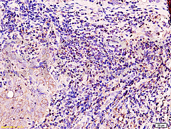 Formalin-fixed and paraffin embedded human nasopharyngeal carcinoma with Anti-BRCA1 Polyclonal Antibody, Unconjugated (bs-0802R) at 1:200, followed by conjugation to the secondary antibody and DAB staining