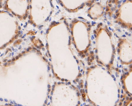 Paraformaldehyde-fixed, paraffin embedded Human thyroid; Antigen retrieval by boiling in sodium citrate buffer (pH6.0) for 15min; Block endogenous peroxidase by 3% hydrogen peroxide for 20 minutes; Blocking buffer (normal goat serum) at 37°C for 30min; Antibody incubation with ICAD Monoclonal Antibody, Unconjugated (bsm-54674R) at 1:400 for 30 minutes at room temperature, DAB staining.