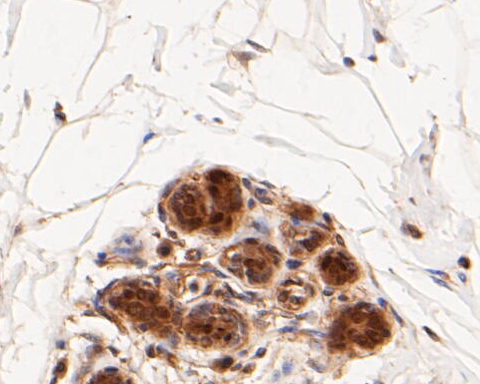 Paraformaldehyde-fixed, paraffin embedded Human breast; Antigen retrieval by boiling in sodium citrate buffer (pH6.0) for 15min; Block endogenous peroxidase by 3% hydrogen peroxide for 20 minutes; Blocking buffer (normal goat serum) at 37°C for 30min; Antibody incubation with ICAD Monoclonal Antibody, Unconjugated (bsm-54674R) at 1:400 for 30 minutes at room temperature, DAB staining.