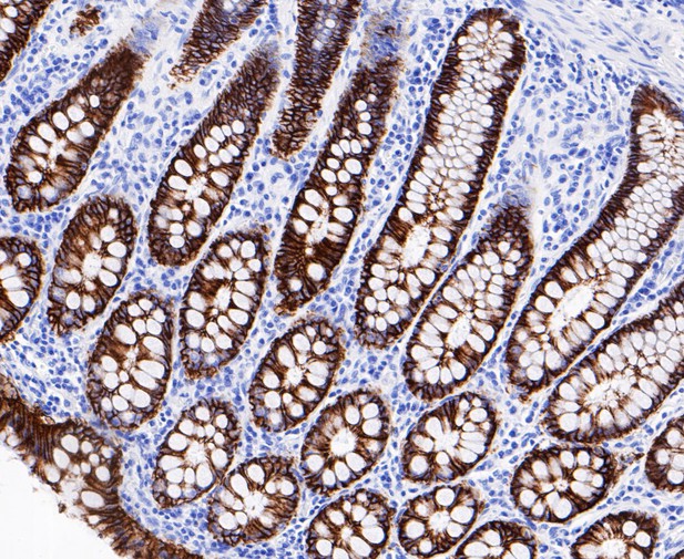 Paraformaldehyde-fixed, paraffin embedded Human colon; Antigen retrieval by boiling in sodium citrate buffer (pH6.0) for 15min; Block endogenous peroxidase by 3% hydrogen peroxide for 20 minutes; Blocking buffer (normal goat serum) at 37°C for 30min; Antibody incubation with GPA33 Monoclonal Antibody, Unconjugated (bsm-54676R) at 1:200 for 30 minutes at room temperature, DAB staining.