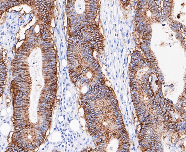 Paraformaldehyde-fixed, paraffin embedded Human colon cancer; Antigen retrieval by boiling in sodium citrate buffer (pH6.0) for 15min; Block endogenous peroxidase by 3% hydrogen peroxide for 20 minutes; Blocking buffer (normal goat serum) at 37°C for 30min; Antibody incubation with GPA33 Monoclonal Antibody, Unconjugated (bsm-54676R) at 1:200 for 30 minutes at room temperature, DAB staining.