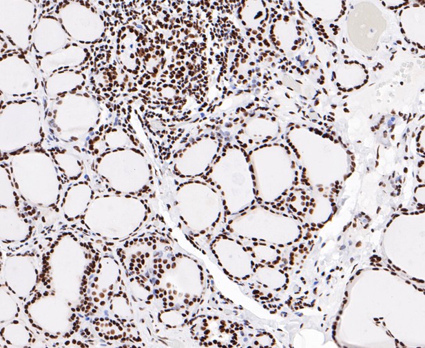 Paraformaldehyde-fixed, paraffin embedded Human thyroid; Antigen retrieval by boiling in sodium citrate buffer (pH6.0) for 15min; Block endogenous peroxidase by 3% hydrogen peroxide for 20 minutes; Blocking buffer (normal goat serum) at 37°C for 30min; Antibody incubation with EWSR1/EWS Monoclonal Antibody, Unconjugated (bsm-54677R) at 1:50 for 30 minutes at room temperature, DAB staining.